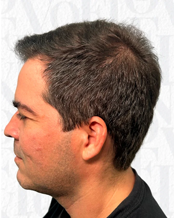 O mesmo paciente de perfil depois do transplante capilar FUE